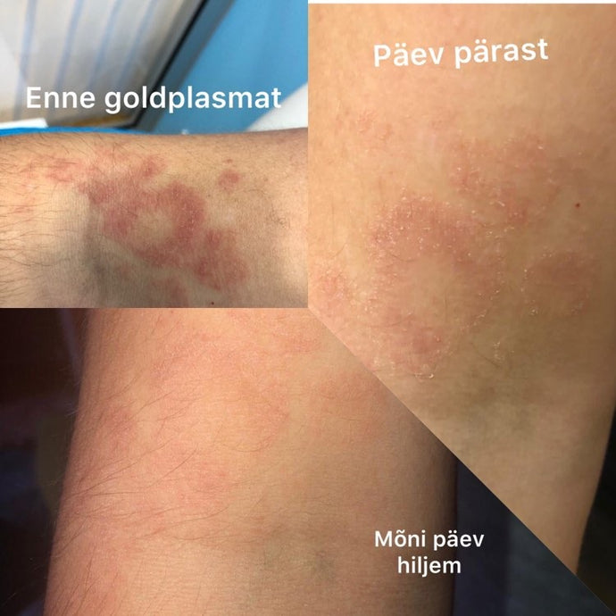 Mis on GoldPlasma ja mille jaoks seda kasutatakse?