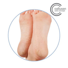 Load image into Gallery viewer, Callusan Forte odorless foam cream for diabetic feet (UREA &gt;15%). 125ml
